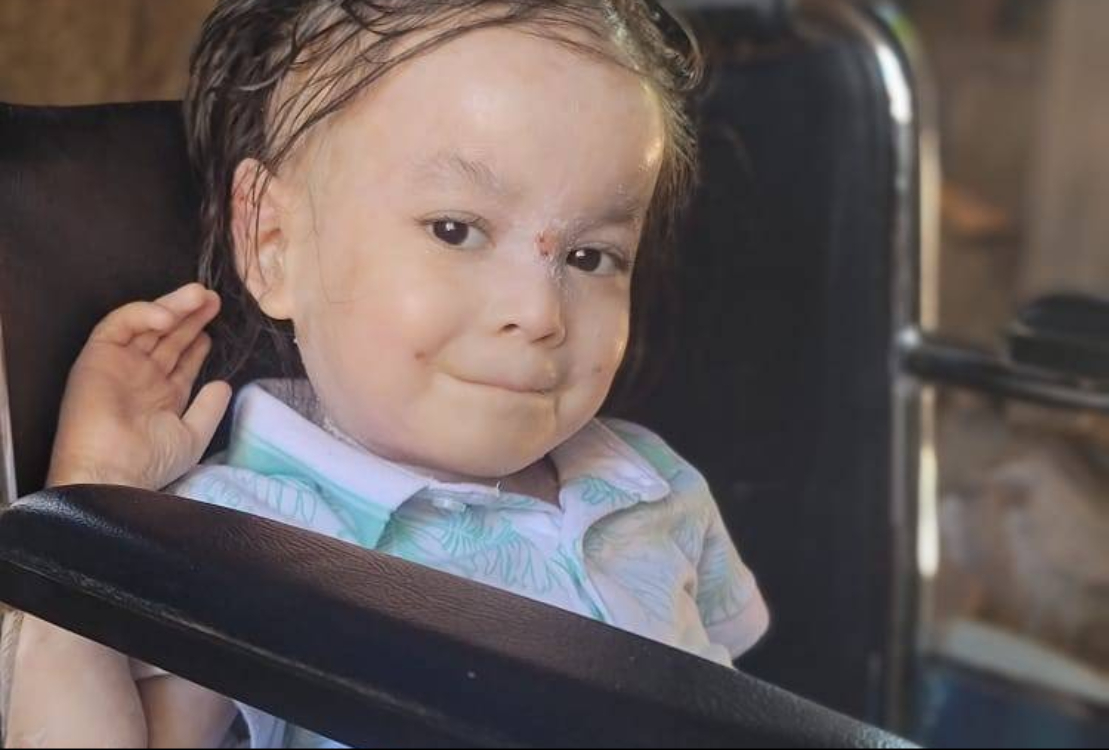 Madre urge ayuda para pagar tratamiento de su niño con laceraciones y ampollas en la piel