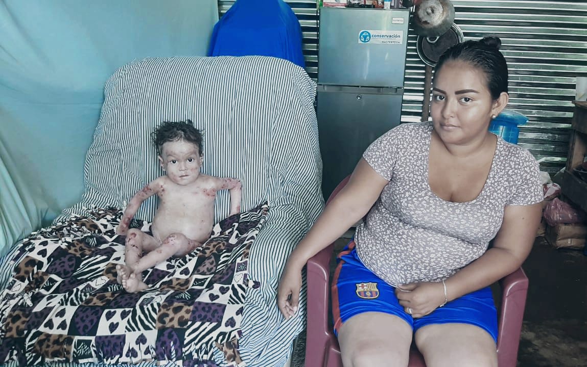 Jonathan, el niño con piel de mariposa que se aferra a la vida