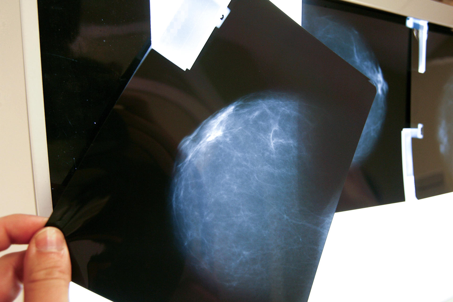 Expertos alertan sobre la falta de registros de cáncer de mamá en América Latina